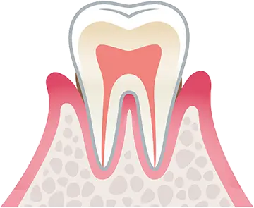 歯周炎（軽度）