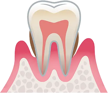 歯周炎（中度）